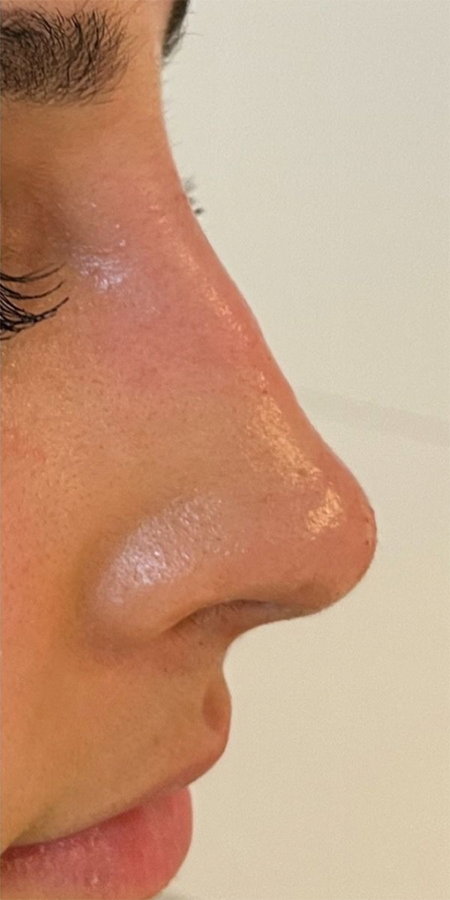 Resultaat van een filler behandeling voor het corrigeren van de neus bij Kliniek 88